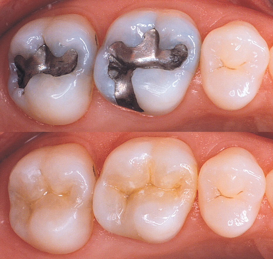 Tooth Cavity Filling Before And After