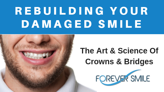Rebuilding Your Damaged Smile With Crowns And Bridges